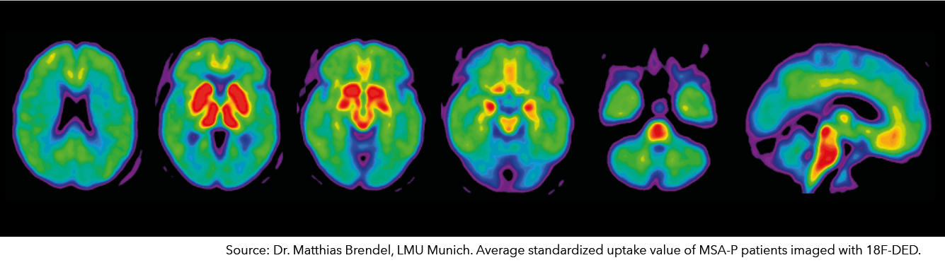 18F-DED – MAO-B Imaging 