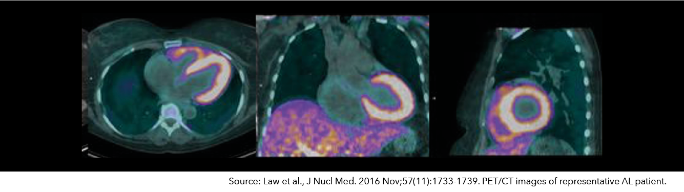 Florbetaben – Cardiac Amyloid Imaging 
