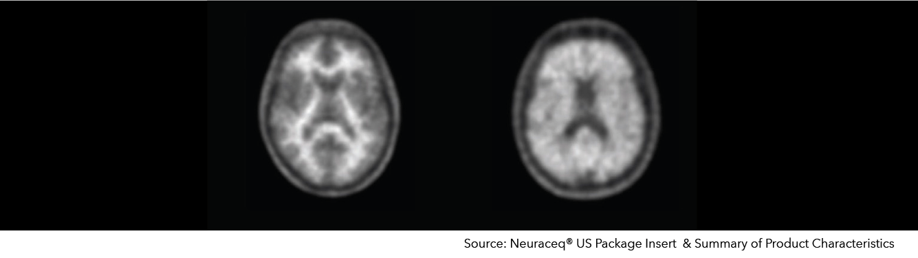 Neuraceq<sup>®</sup> – Beta Amyloid Imaging 
