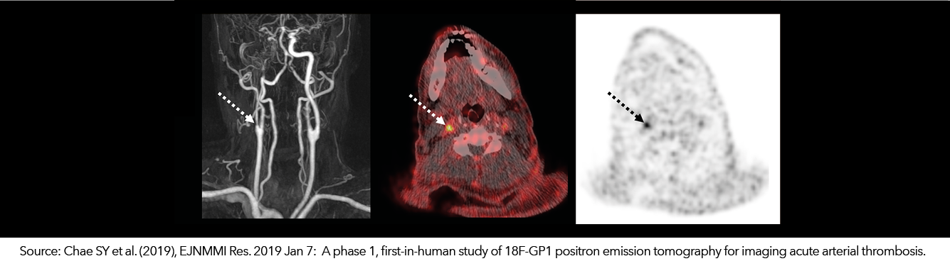 18F-GP1 – Thrombus Imaging 