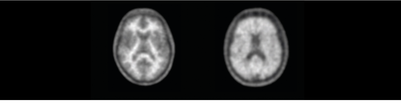 Beta Amyloid Imaging